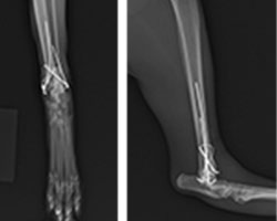 脛骨遠位端内顆、外顆骨の剥離骨折を伴う足根関節脱臼