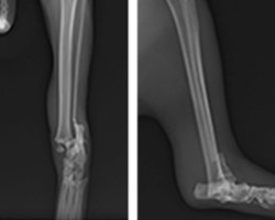 脛骨遠位端内顆、外顆骨の剥離骨折を伴う足根関節脱臼