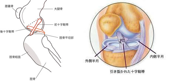 ACL断裂の治療