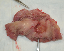 胃腫瘍