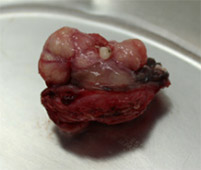 顎の腫瘍